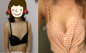 北京雅靚假體隆胸真人案例看張春彥隆胸技術(shù)是否靠譜？