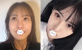 雙眼皮術后1年又花1W多來深圳潤澤瑞尼絲做耳軟骨復合隆鼻