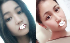 花2W多價(jià)格找深圳美加美周?chē)?guó)偉做自體肋軟骨鼻綜合值了