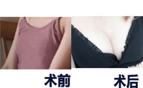 長沙雅美醫(yī)療美容醫(yī)院隆胸手術(shù)案例對比圖