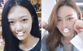 趁價格優(yōu)惠找深圳美麗方案整形姚堯做鼻綜合隆鼻+雙眼皮