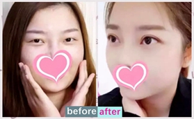 沈陽星美王志濤切開雙眼皮+去皮+去脂+翹睫案例