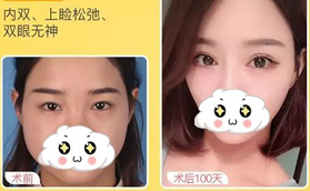 找蚌埠美萊塢張迪做了無痕全切雙眼皮誰還貼雙眼皮貼啊