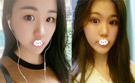 在深圳美顏做眼部整形后知道為什么做雙眼皮都要開眼角