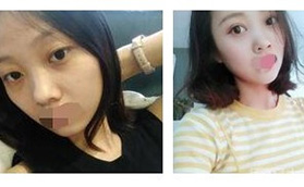 淄博美聯(lián)臣雙眼皮+開(kāi)眼角術(shù)后一個(gè)月效果自然嗎