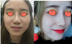 在金華瑞麗整形硅膠假體隆鼻失敗修復(fù)，成功找回了自信！