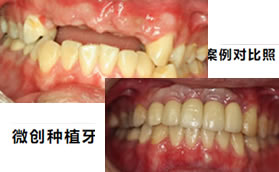 韓國登騰種植牙價格比奧齒泰便宜,但質量并不差,和真牙一樣