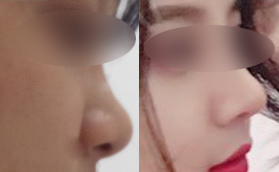 找南寧美麗星李武斌做硅膠隆鼻+耳軟骨墊鼻尖術(shù)后驚艷效果