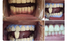 牙齒發(fā)黃的我,在南京雅度口腔做完皓齒美白后對(duì)比照片分享