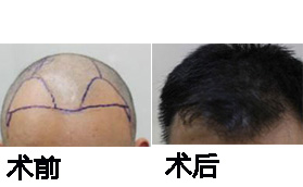 長(zhǎng)沙協(xié)雅整形美容醫(yī)院毛發(fā)移植案例