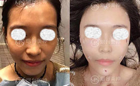 煙臺(tái)美神科美整形美容醫(yī)院面部自體脂肪填充前后對(duì)比案例