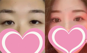 廣州華美整形醫(yī)院雙眼皮開眼角案例前后對比照