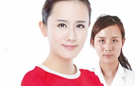 婁底愛思特醫(yī)療美容醫(yī)院孫黎明美式亮瞳大眼術(shù)案例