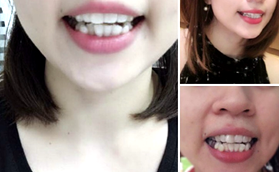 南京博韻口腔醫(yī)院（定淮門院）隱適美牙齒矯正案例分享