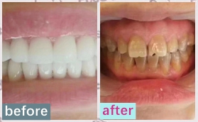 沈陽米蘭口腔氟斑牙/四環(huán)素牙瓷貼面美白修復(fù)案例