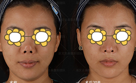 兩次隆鼻失敗變朝天鼻五萬(wàn)找北京米揚(yáng)麗格巫文云做鼻修復(fù)