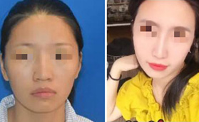 真實投稿武漢亞韓趙貴慶磨骨案例，4萬就能讓臉型明顯改變