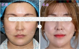 煙臺(tái)華怡整形醫(yī)院面部吸脂案例前后對(duì)比圖