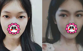 想知道太原麗都楊明峰眼睛做的咋樣,來(lái)看看我的雙眼皮變化