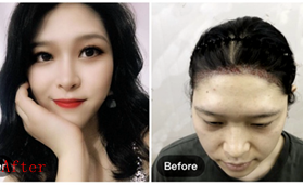 南京鼓樓新生醫(yī)療美容孫秀坤發(fā)際線種植案例分享