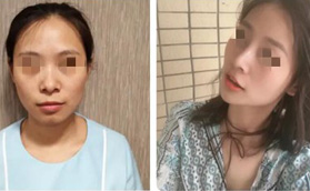 了解武漢美基元汪福強(qiáng)口碑后，找他做鼻綜合手術(shù)花了3萬多