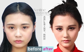 沈陽(yáng)杏林整形醫(yī)院朱石江下頜角縮小術(shù)+硅膠隆鼻案例