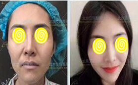 韋元強脂肪豐面兩萬元起看北京艾瑪面部填充案例及價格表