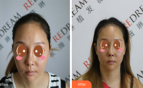 花兩萬多找北京薇琳竇云軻做發(fā)際線種植七天恢復圖