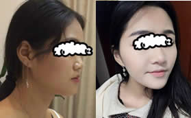 重慶聯(lián)合麗格黨寧做射極峰膨體隆鼻,一年后高度沒變矮很多