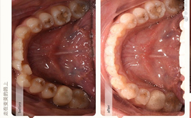 ?經(jīng)過(guò)太原眾牙1年的隱形牙齒矯正感覺(jué)隱適美的缺點(diǎn)就是貴