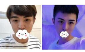 景德鎮(zhèn)圣嘉麗醫(yī)療美容鼻部綜合整形前后對比