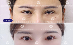 王世勇修復雙眼皮多少錢？案例價格表看北京東方百合正規(guī)