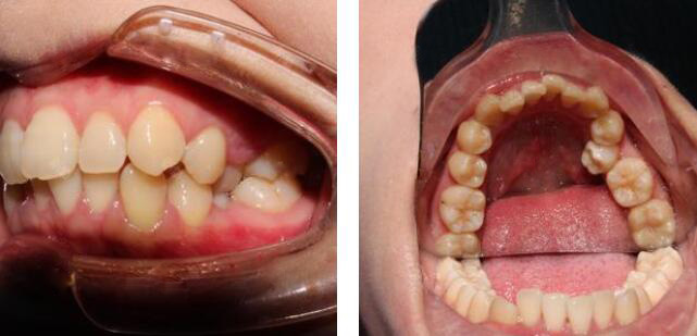 在深圳韋博口腔做半隱形陶瓷托槽矯正,感覺收費合理效果好