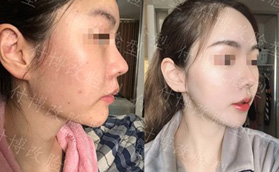 武漢華美付國友磨骨技術怎么樣？看我花了3萬找他做下頜角