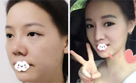 我的鼻綜合修復(fù)花了2W多，大家看深圳盛美佳隆鼻整形怎么樣