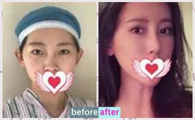 沈陽云惠美醫(yī)療美容做完耳軟骨復(fù)合隆鼻后竟不懼揉捏