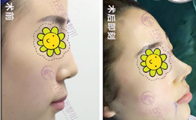 南充五星整形美容醫(yī)院肋軟骨隆鼻術前術后即刻對比照