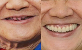 看深圳登特口腔種牙靠譜 全口種植牙價格合理做了即拔即種