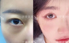 閨蜜陪我去做雙眼皮失敗修復，術后效果讓她沖動做了切開