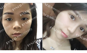 在惠州鵬愛做了開扇形雙眼皮剛拆線，就又做了耳軟骨隆鼻