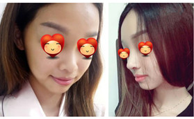 沒看王濱福的肋骨鼻案例前,我也怕術(shù)后會像鷹鉤鼻鼻尖下墜