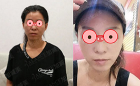 北京加減美穆寶安價格七萬多V美減齡面部提升案例分享