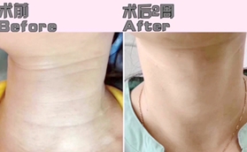 沈陽瑞妍醫(yī)療美容診所譚佳男嗨體去頸紋，美出天鵝頸