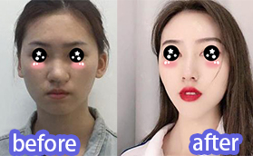 我在廈門(mén)酉西兒找莊錦波肋軟骨隆鼻100天效果對(duì)比圖