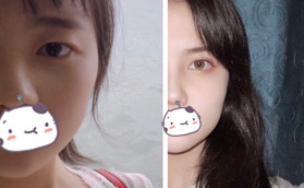 高中畢業(yè)在惠州時光做全切雙眼皮花了5000元，效果像媽生的