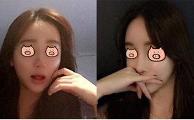 我打瑞藍(lán)玻尿酸4次山根變寬，找到惠州劉偉勇做了鼻綜合