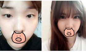 天了嚕！青海潤(rùn)美做的扇形雙眼皮竟然五天就拆線！