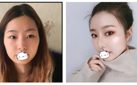 拯救小內雙，我找蘇州圣愛胡慧敏做全切雙眼皮效果挺自然