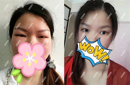 腫眼泡的我預約武漢卓美吳秀英做雙眼皮后發(fā)現(xiàn)技術(shù)很靠譜