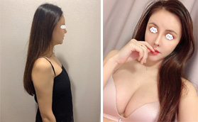 花8萬找深圳米蘭柏羽朱武根用內(nèi)窺鏡做傲諾拉閃耀假體隆胸